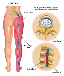 medical illustration of symptoms of the sciatica